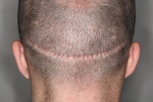 alopecia_cicatrizal