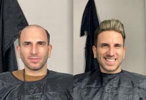 Prótesis capilares en Madrid para hombre y mujer: innovación y naturalidad