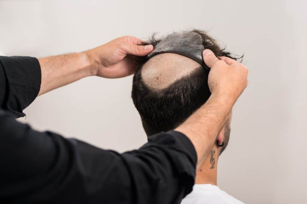 Prótesis capilares en Madrid para hombre y mujer: innovación y naturalidad