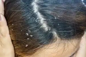 dermatitis seborreica cuero cabelludo