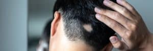 alopecia