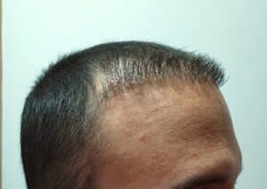 injerto capilar mal hecho