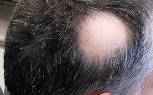 alopecia