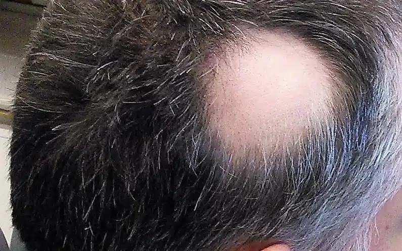 alopecia