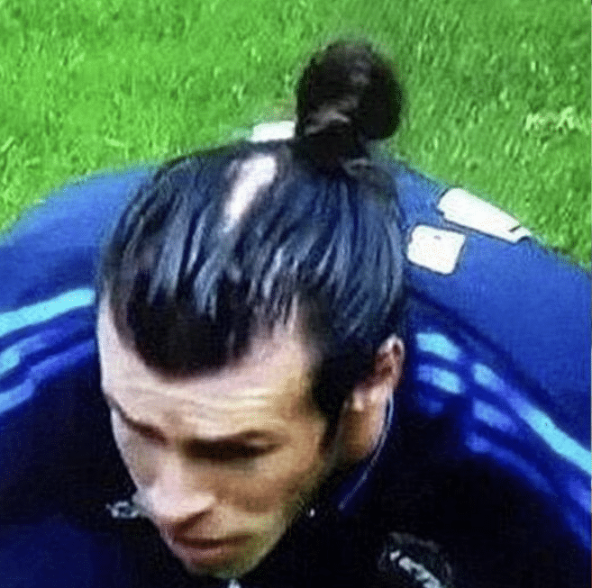gareth bale implante