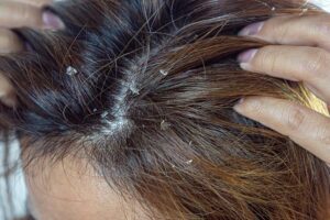 dermatitis seborreica cuero cabelludo
