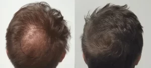 mesoterapia capilar