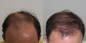 Plasma rico en plaquetas (PRP) para el cabello: resultados antes y después