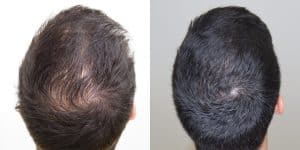 Plasma rico en plaquetas (PRP) para el cabello: resultados antes y después