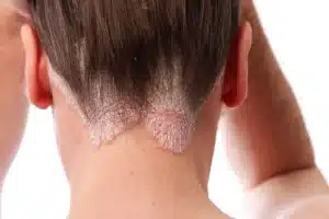 psoriasis pelo