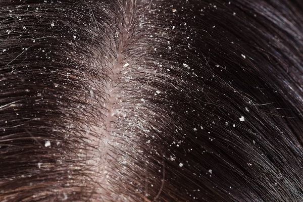 Tratamiento eficaz para la dermatitis seborreica en el cuero cabelludo