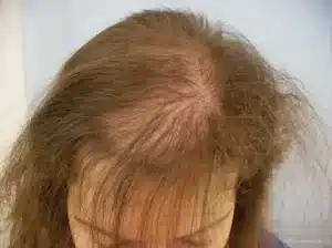 La caída de pelo por estrés y nervios en mujeres es un problema que ha ido en aumento en la sociedad actual. Los altos niveles de estrés no solo afectan la salud mental y física, sino también el bienestar de nuestro cabello, pudiendo conducir a una condición conocida como alopecia nerviosa.