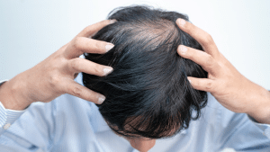 como prevenir la caida de cabello