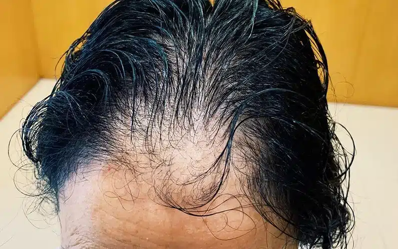 alopecia androgenética