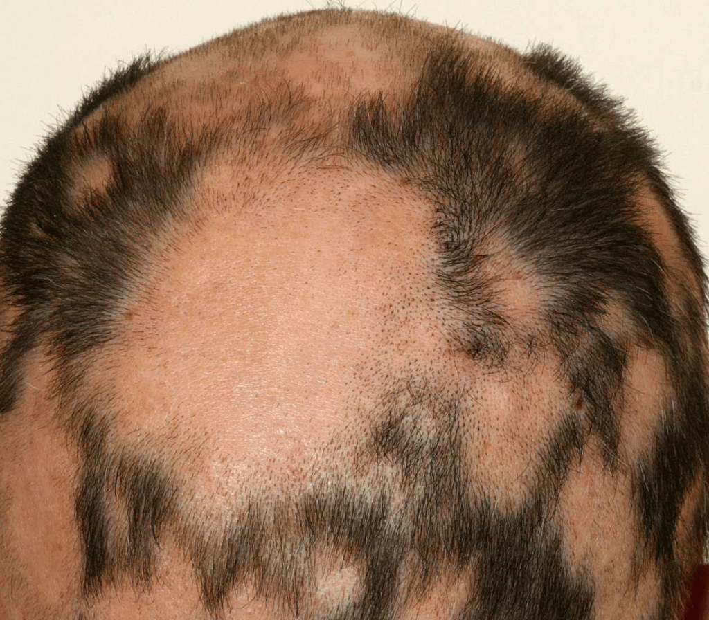 alopecia