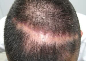 alopecia_cicatrizal