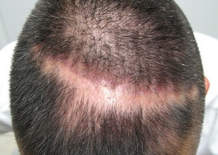 alopecia_cicatrizal