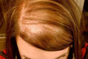 alpoecia difusa en mujeres