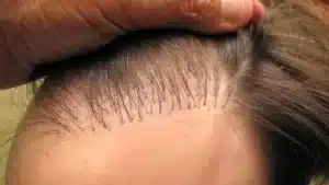 injerto capilar mal hecho