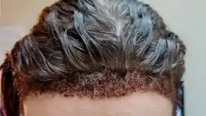 injerto capilar mal hecho
