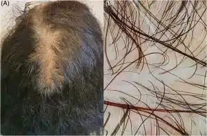 Efluvio telógeno