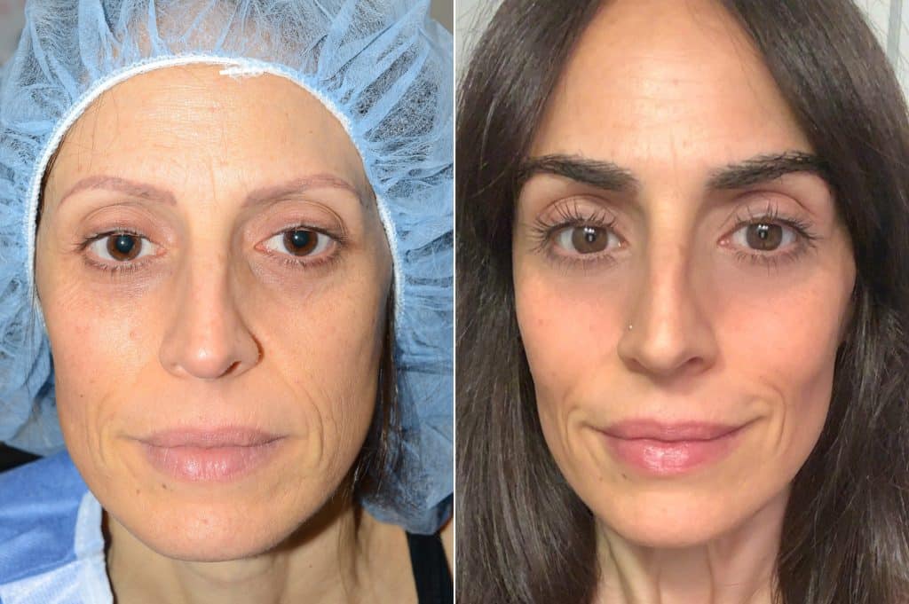 transplante de cejas