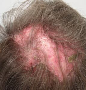 Foliculitis decalvante
