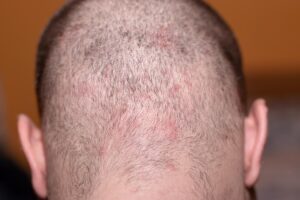 acne capilar