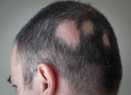 tipos de alopecia