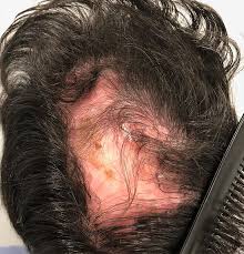 Foliculitis decalvante