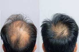 Plasma rico en plaquetas (PRP) para el cabello: resultados antes y después