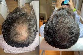 Plasma rico en plaquetas (PRP) para el cabello: resultados antes y después