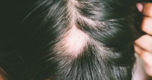 Lupus discoide y caída del cabello