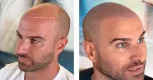 micropigmentacioncapilar-tengo-cabello-largo