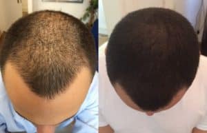 La micropigmentación capilar en Madrid se ha convertido en una solución innovadora para aquellos que buscan combatir los efectos visuales de la alopecia o la pérdida de cabello, ofreciendo una alternativa estética de gran aceptación. Este tratamiento no quirúrgico simula la apariencia de cabello corto o folículos capilares en el cuero cabelludo, mejorando la densidad capilar de una forma natural y con resultados inmediatos.