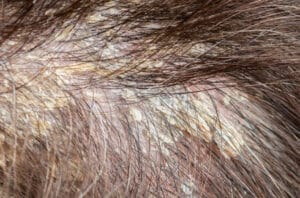 dermatitis seborreica cuero cabelludo