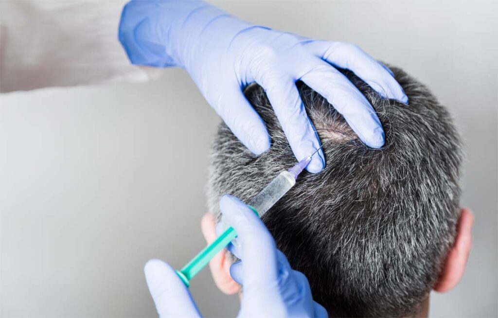 infiltraciones de plasma cabello