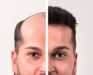 Prótesis capilares en Madrid para hombre y mujer: innovación y naturalidad
