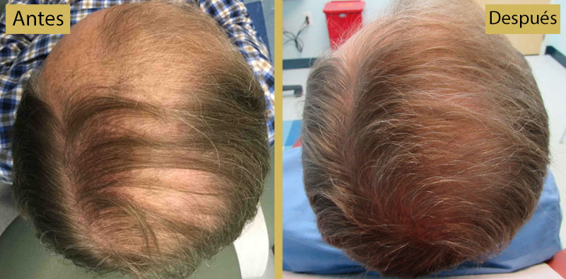 Plasma rico en plaquetas (PRP) para el cabello: resultados antes y después