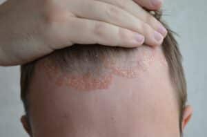 psoriasis pelo