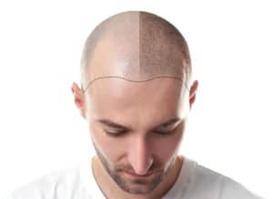 micropigmentacioncapilar-tengo-cabello-largo