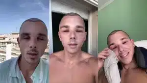 cara hinchada despues de un injerto capilar